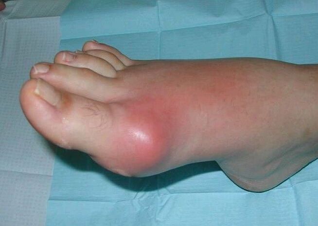 Pēdas artrīta klīniskā aina - pietūkums un iekaisums