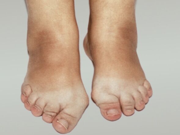 Pēdas osteoartrīts ar smagu kāju pirkstu deformāciju
