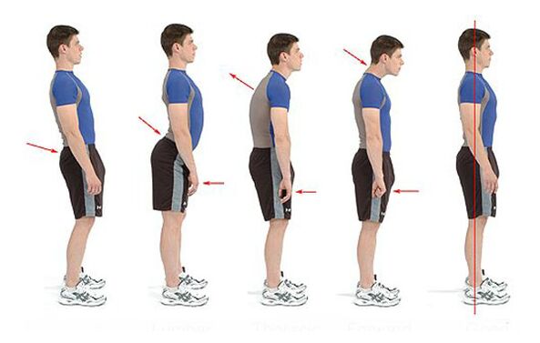 Osteohondrozes profilakse