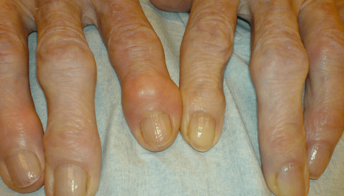 sāpes pirkstu locītavās ar osteoartrītu