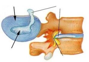 šķiedru gredzena iznīcināšana dzemdes kakla osteohondrozē