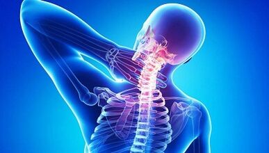 Kā izpaužas osteohondroze
