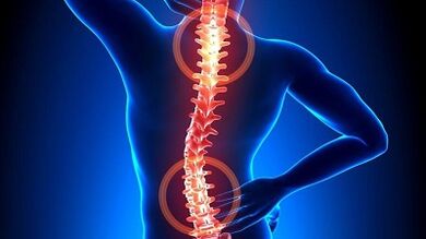 Osteohondrozes attīstības mehānisms