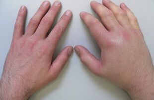 artralģija kā sāpju cēlonis pirkstu locītavās