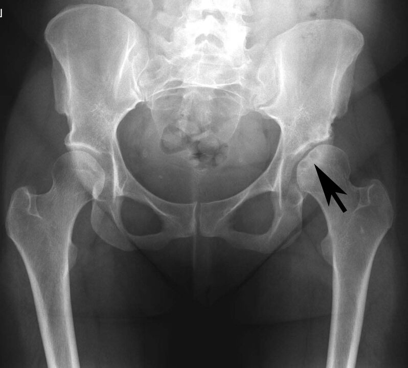 Kalcija sāļu nogulsnēšanās gūžas locītavā ar pseidopodagru rentgenā