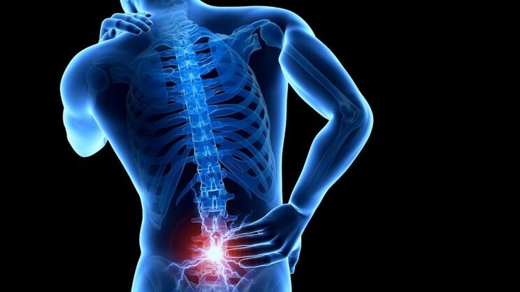 muguras sāpes ar jostas daļas osteohondrozi