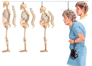 kā izskatās osteohondroze